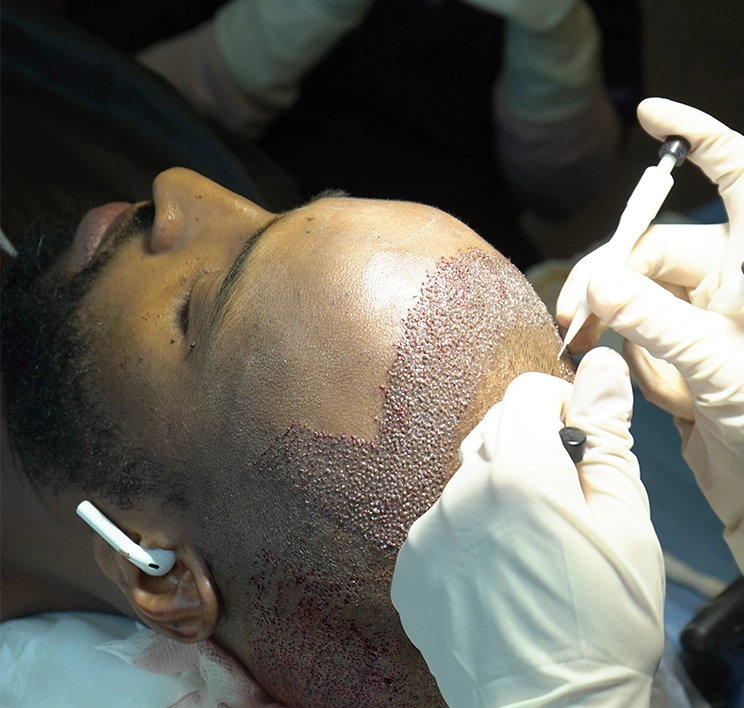 HOW TO DO HAIR TRANSPLANTATION IN TURKEY